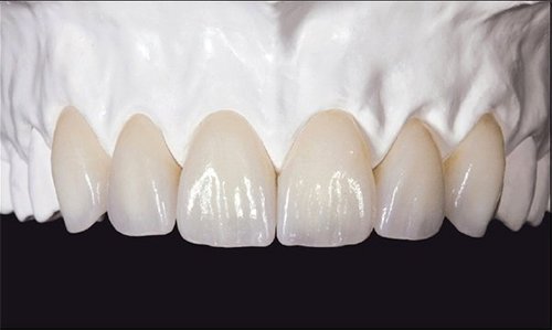 Răng sứ Zirconia có mấy loại?