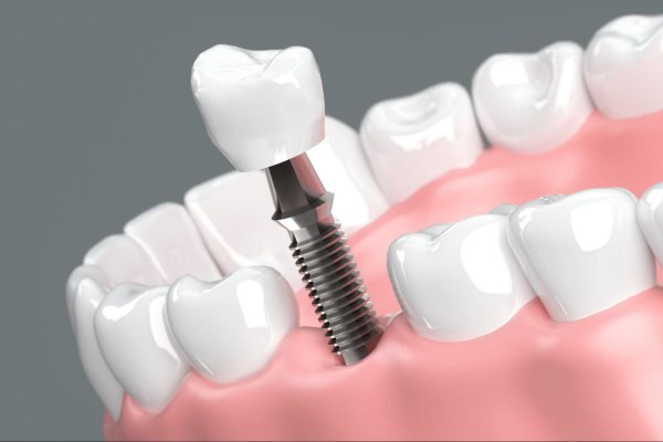 Sau khi nhổ răng bao lâu thì trồng implant?