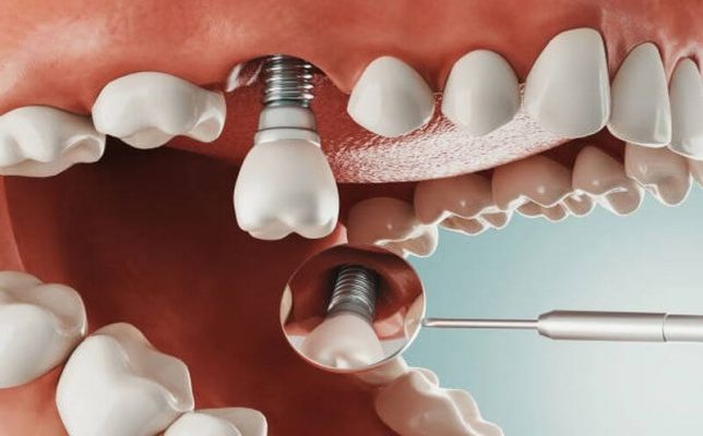 Cùng tìm hiểu về kỹ thuật cấp ghép implant tức thì