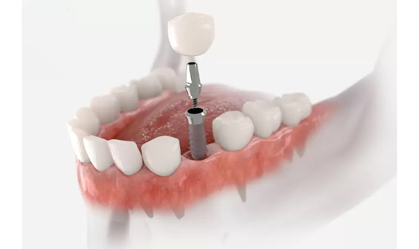 Hậu quả của việc nhiễm trùng răng implant