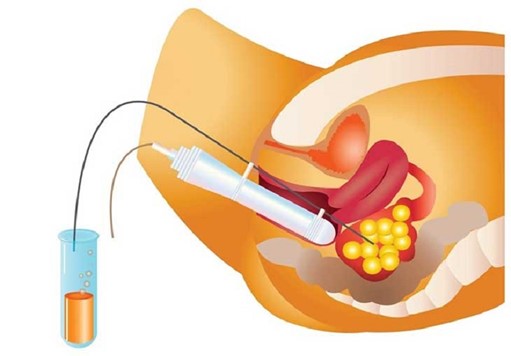 Quá trình chuyển phôi vào tử cung