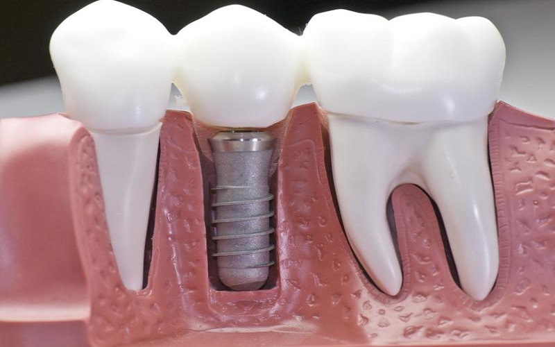 Đặc tính khi trồng răng implant