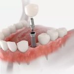 Răng Implant làm từ chất liệu gì?