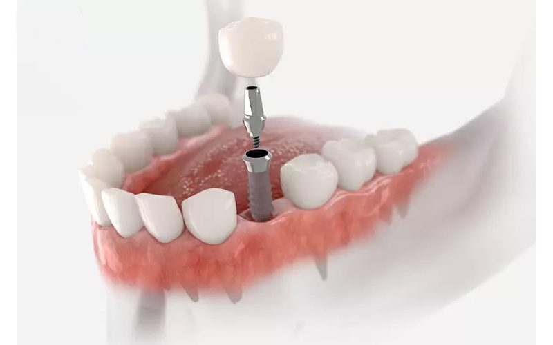 Răng Implant làm từ chất liệu gì?