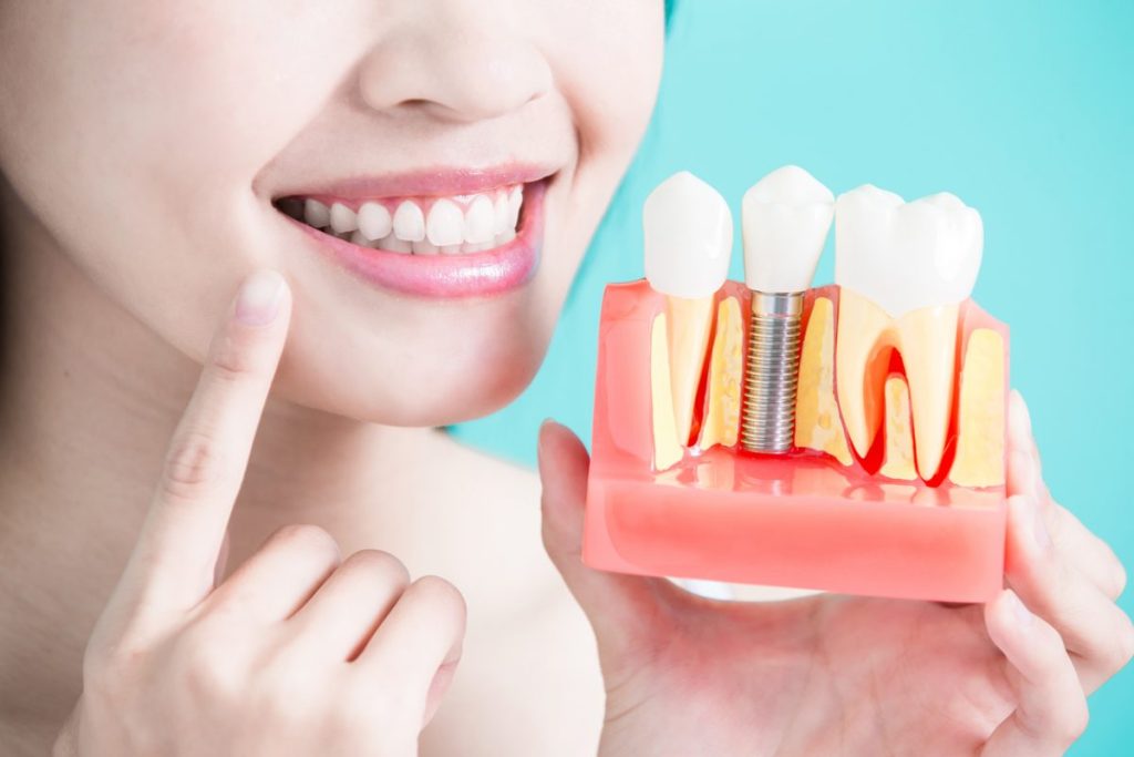 Kiểm tra các bệnh lý về răng trước khi tiến hành cấy ghép Implant