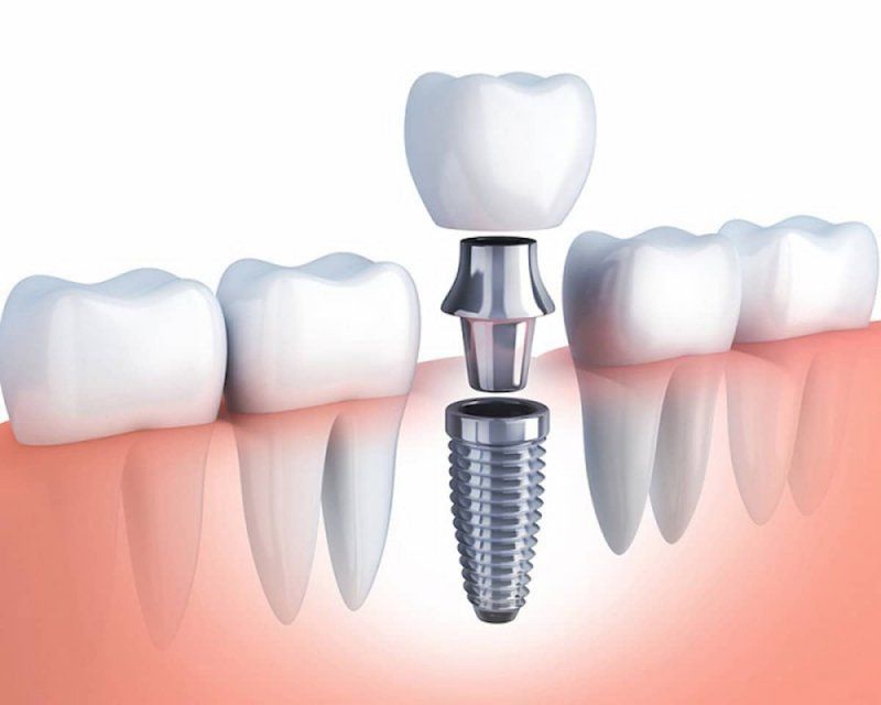 Trụ Implant Straumann