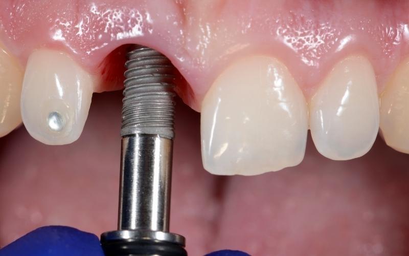 Trồng răng implant có đau không?