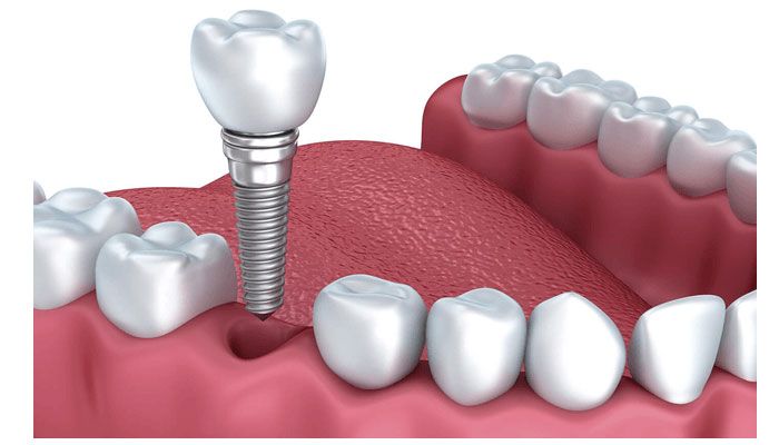 Xét nghiệm về cấy ghép răng implant