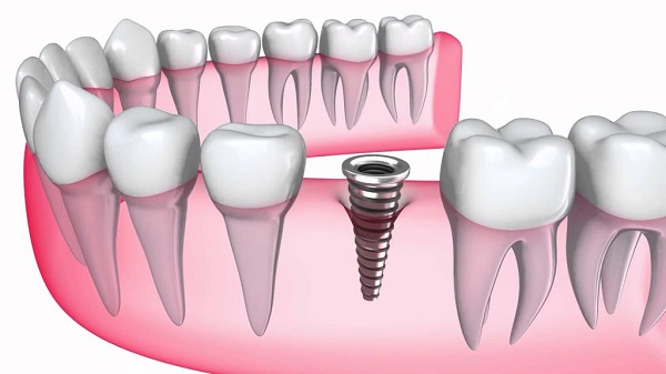 Răng Implant làm từ chất liệu gì?